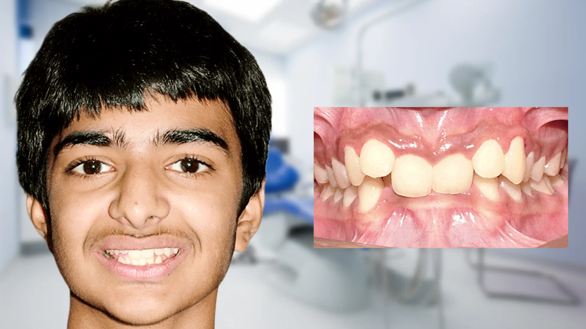 Before treatment - overbite