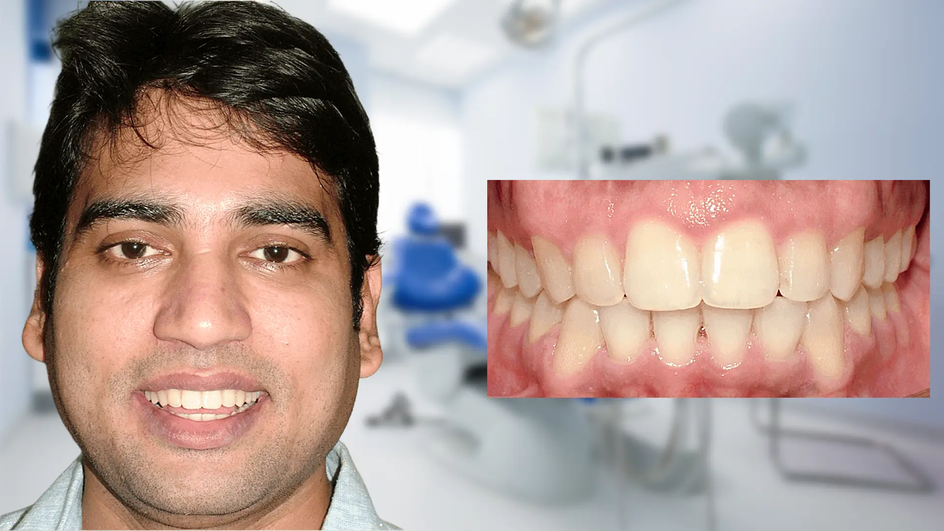 After treatment - corrected tooth