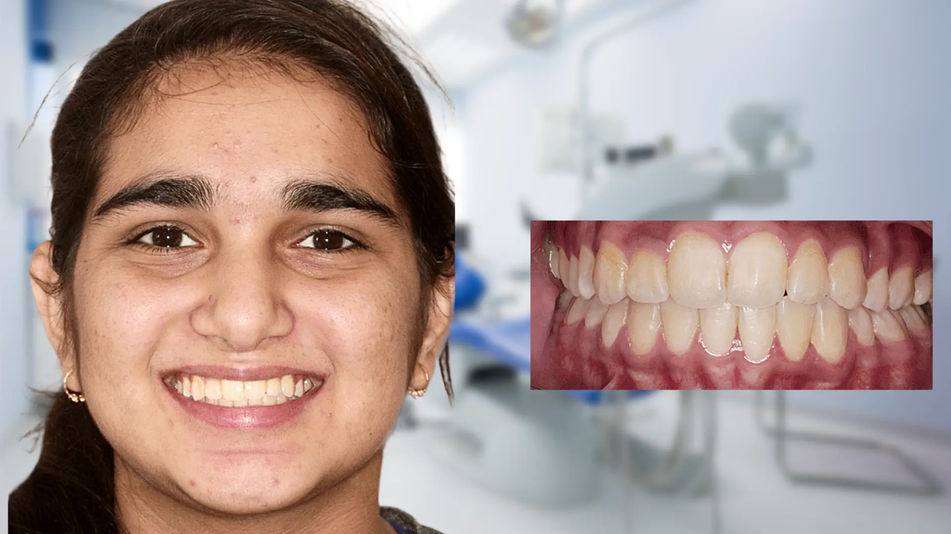 After treatment - aligned teeth