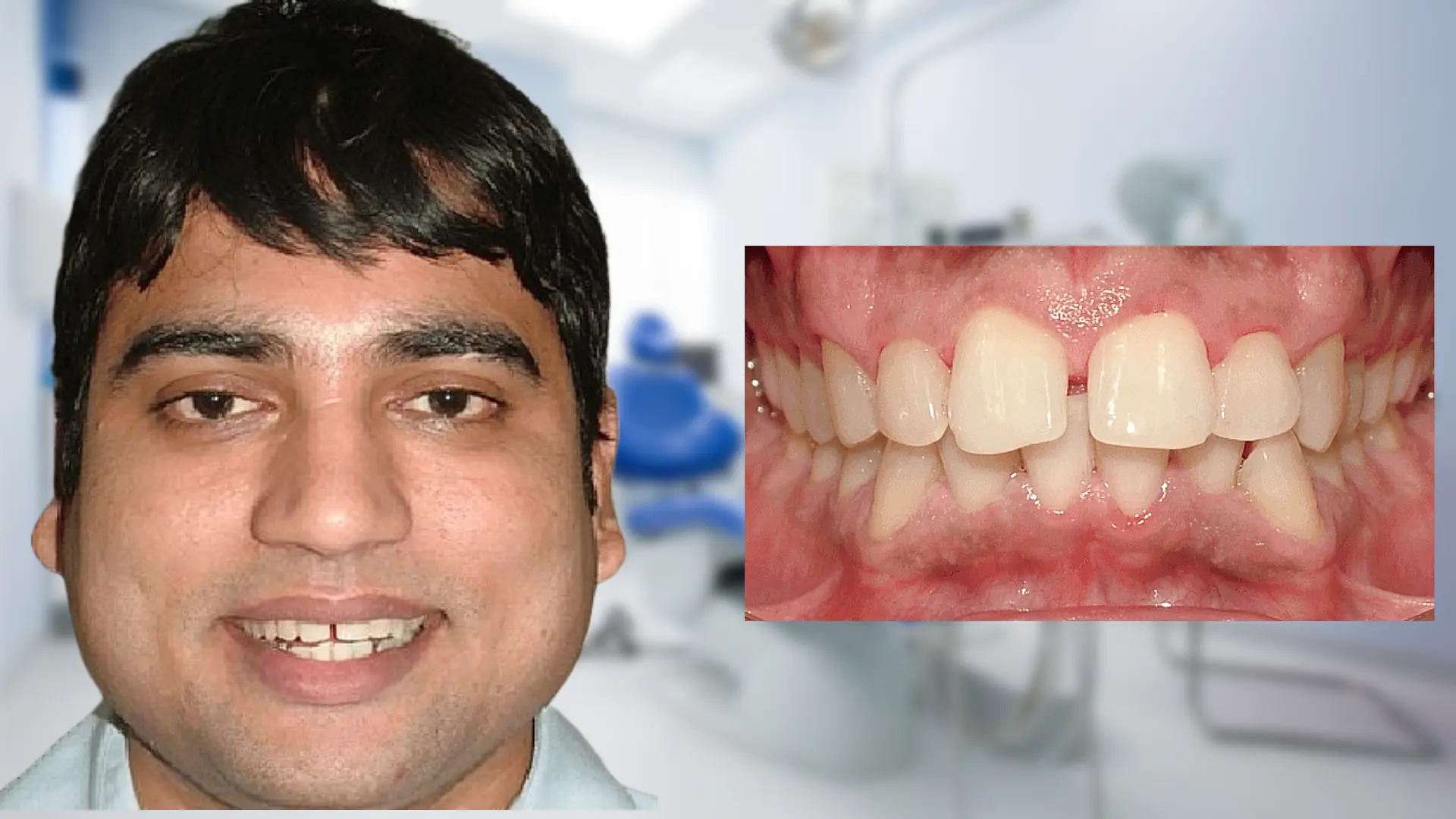 Before treatment - rotated tooth