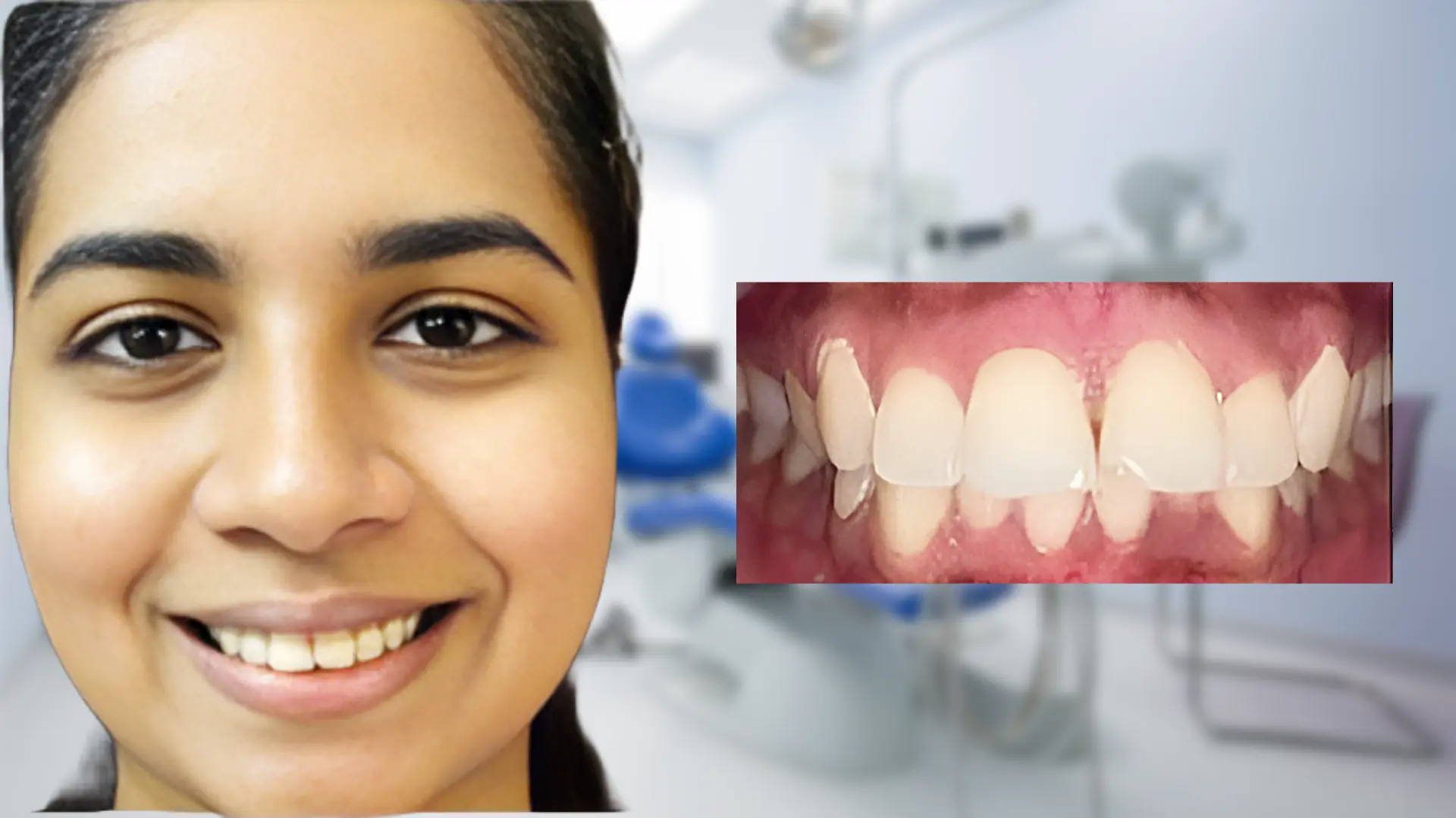 Before treatment - Deep Bite
