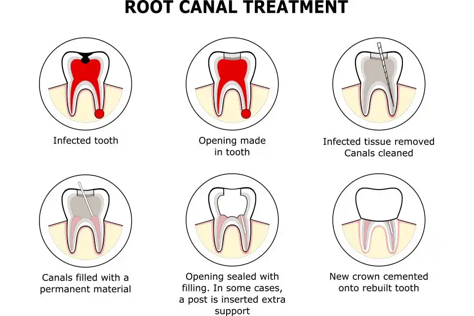 Root Canal Treatment in Gurgaon