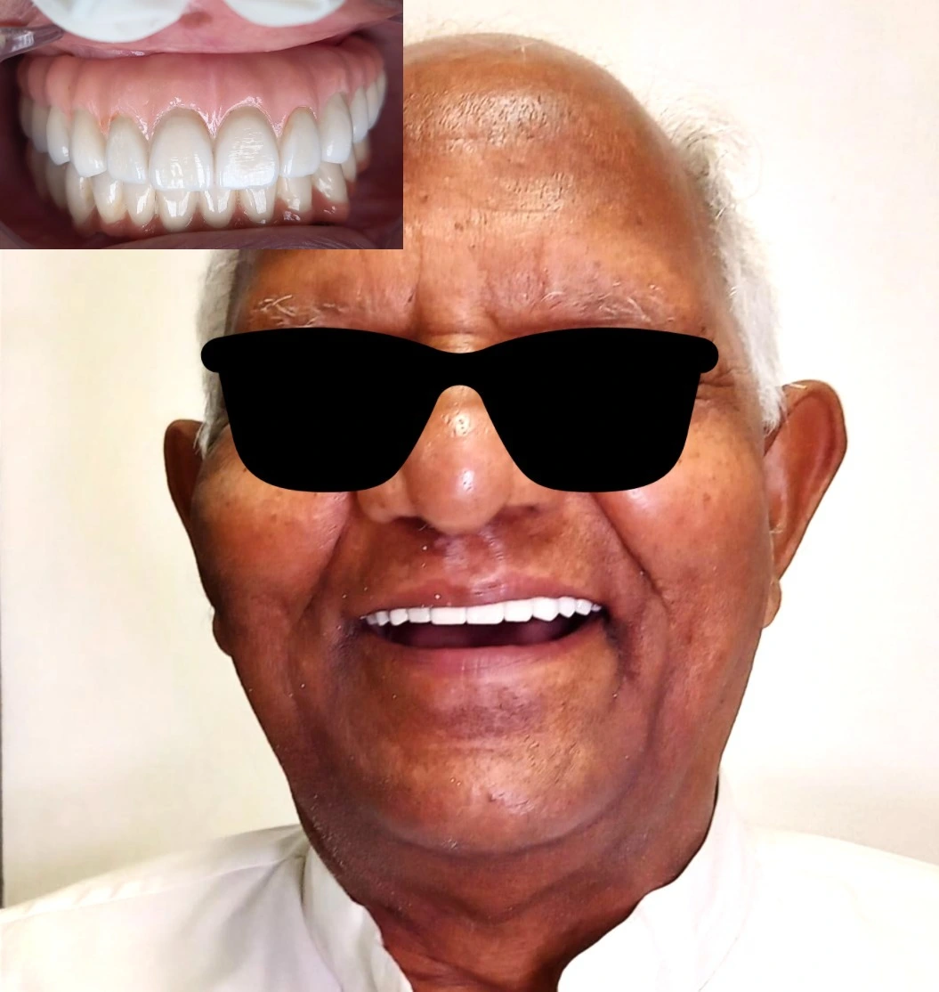 All on 4 Implants in Gurgaon