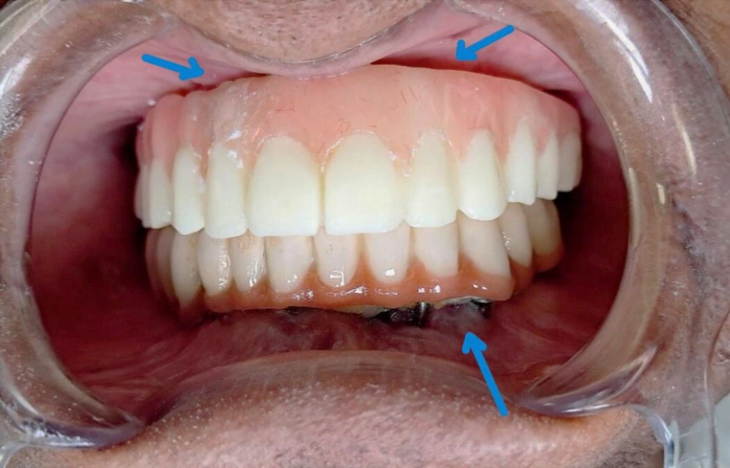 Failed Basal Implant Case Before