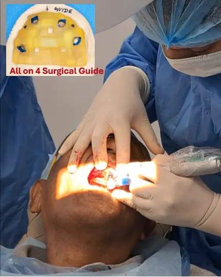 Full Mouth Implants in Gurgaon