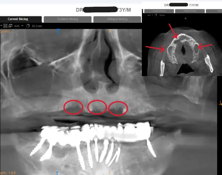 Boneloss on basal implant removal