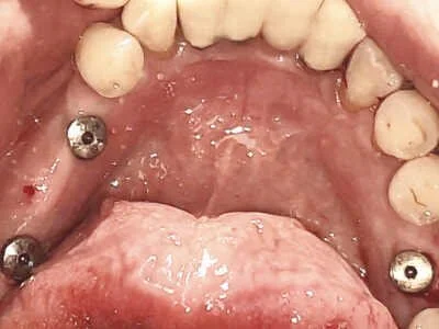 Healing phase after digital implant surgery