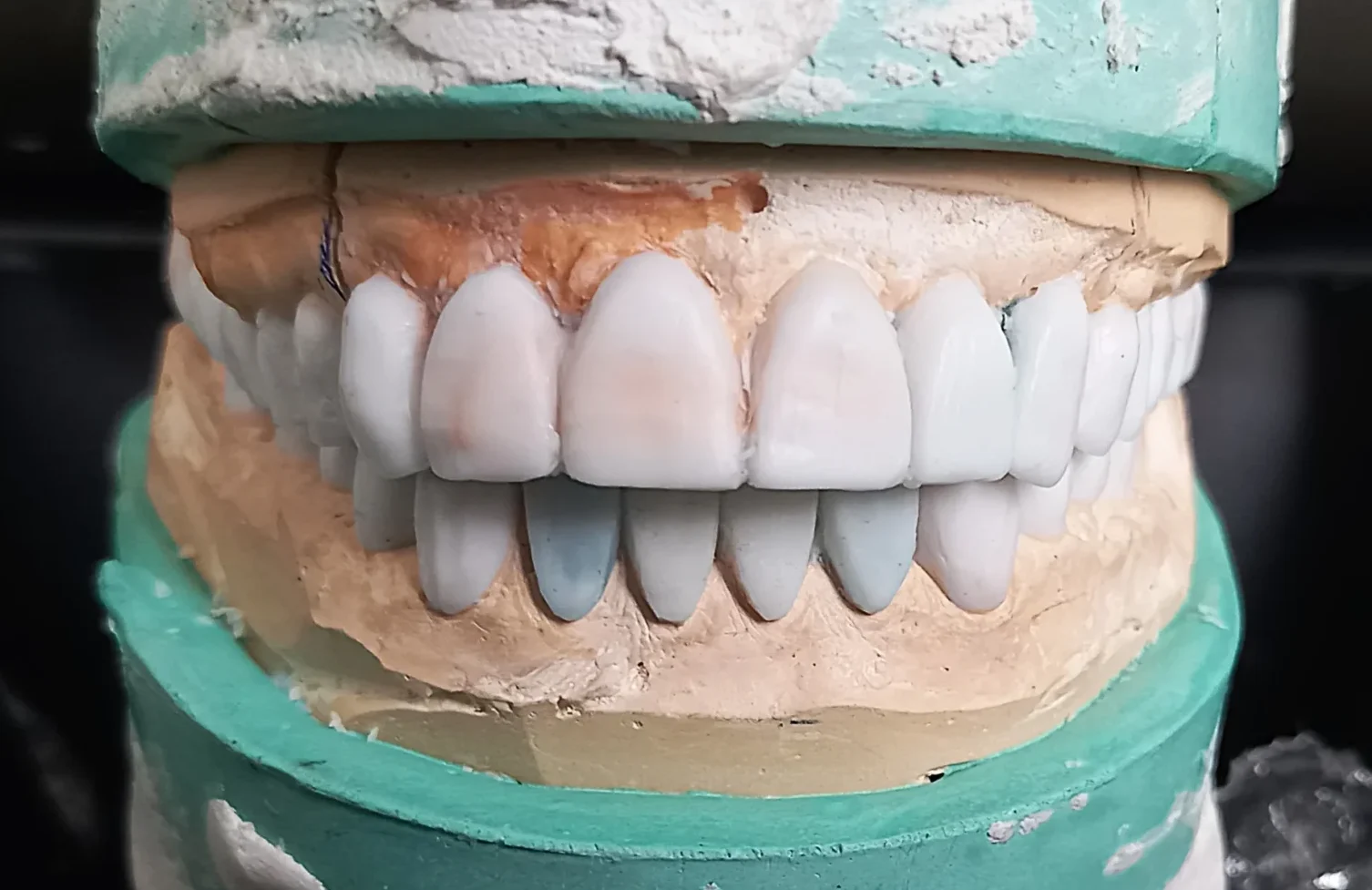 Trial teeth during reconstruction