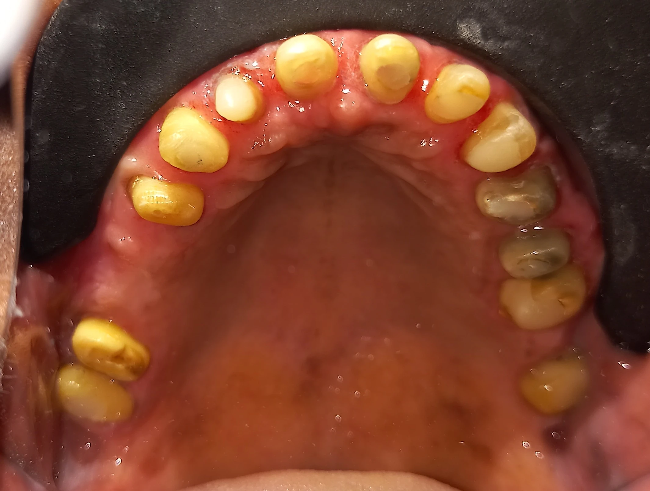 Teeth shaping during Full Mouth Reconstruction