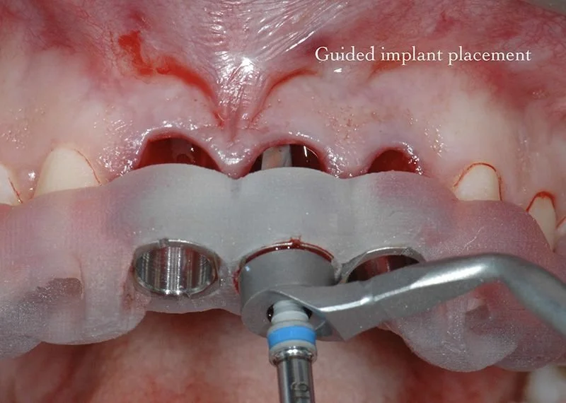Guided implant placement by Dr. Jyoti Singh in Gurgaon