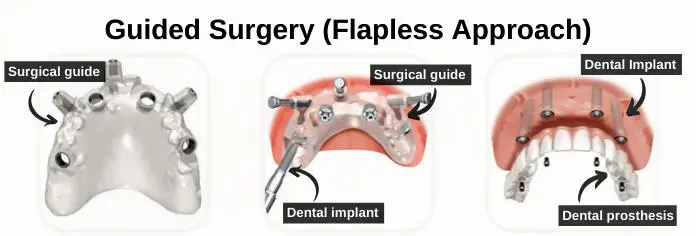 Flapless guided All-on-4 full mouth implant surgery