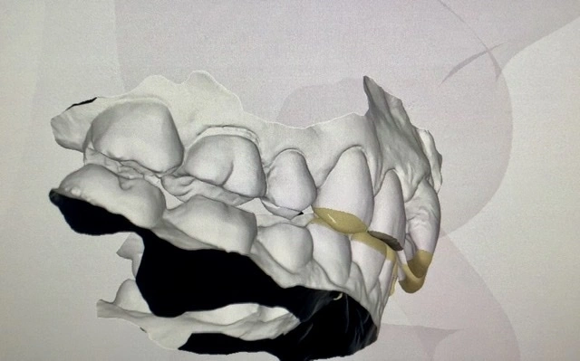 3D Intraoral scan of uneven bite