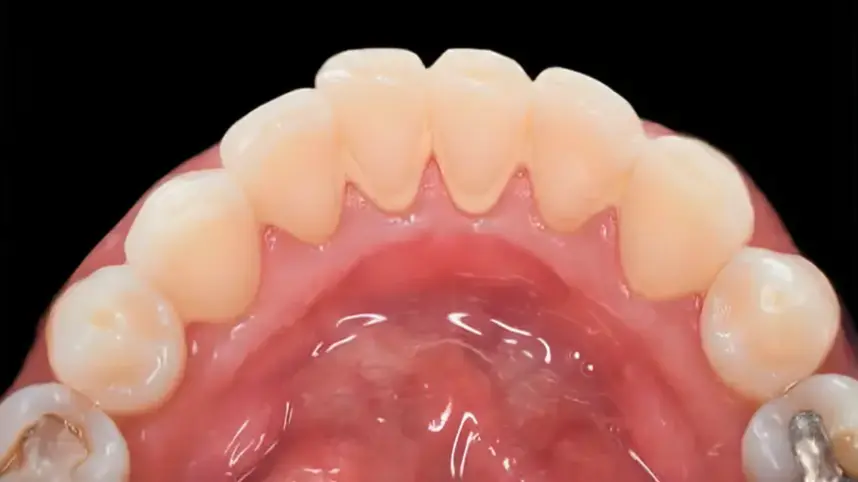 Mild Tartar - Light deposits, minor staining