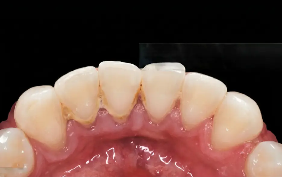 Moderate Tartar - Regular buildup, visible deposits