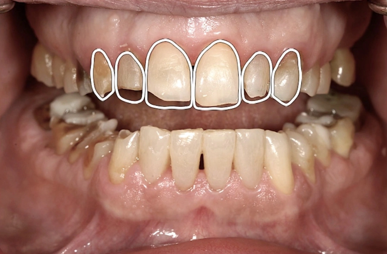 Digital smile design planning