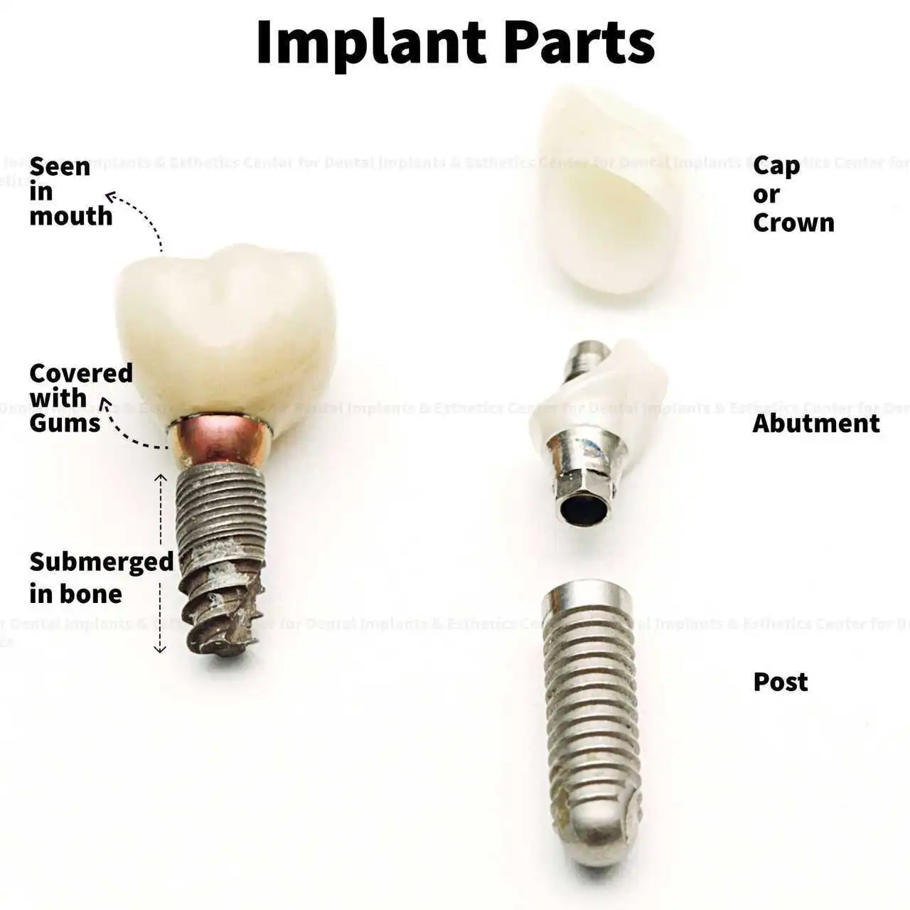Structure of Dental Implant Parts - Fixture, Abutment, Crown