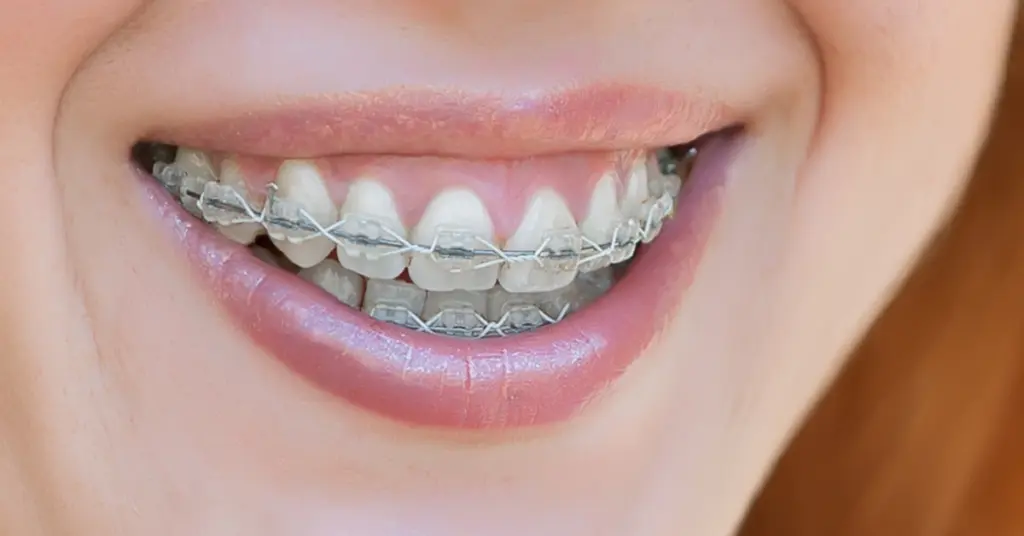 Braces for Adults Age 20 and Above