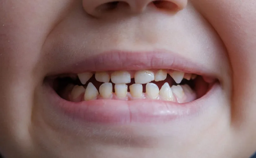 Braces for Children Age 7-12