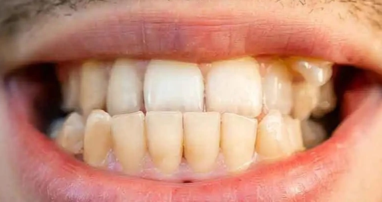 Crossbite Treatment in Gurgaon