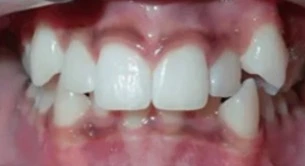 Overbite and Deep Bite Treatment in Gurgaon