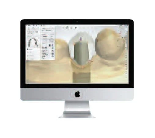 Final dental crown placement in Gurgaon