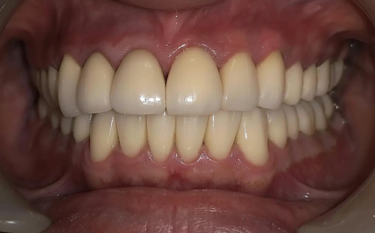 After full mouth reconstruction