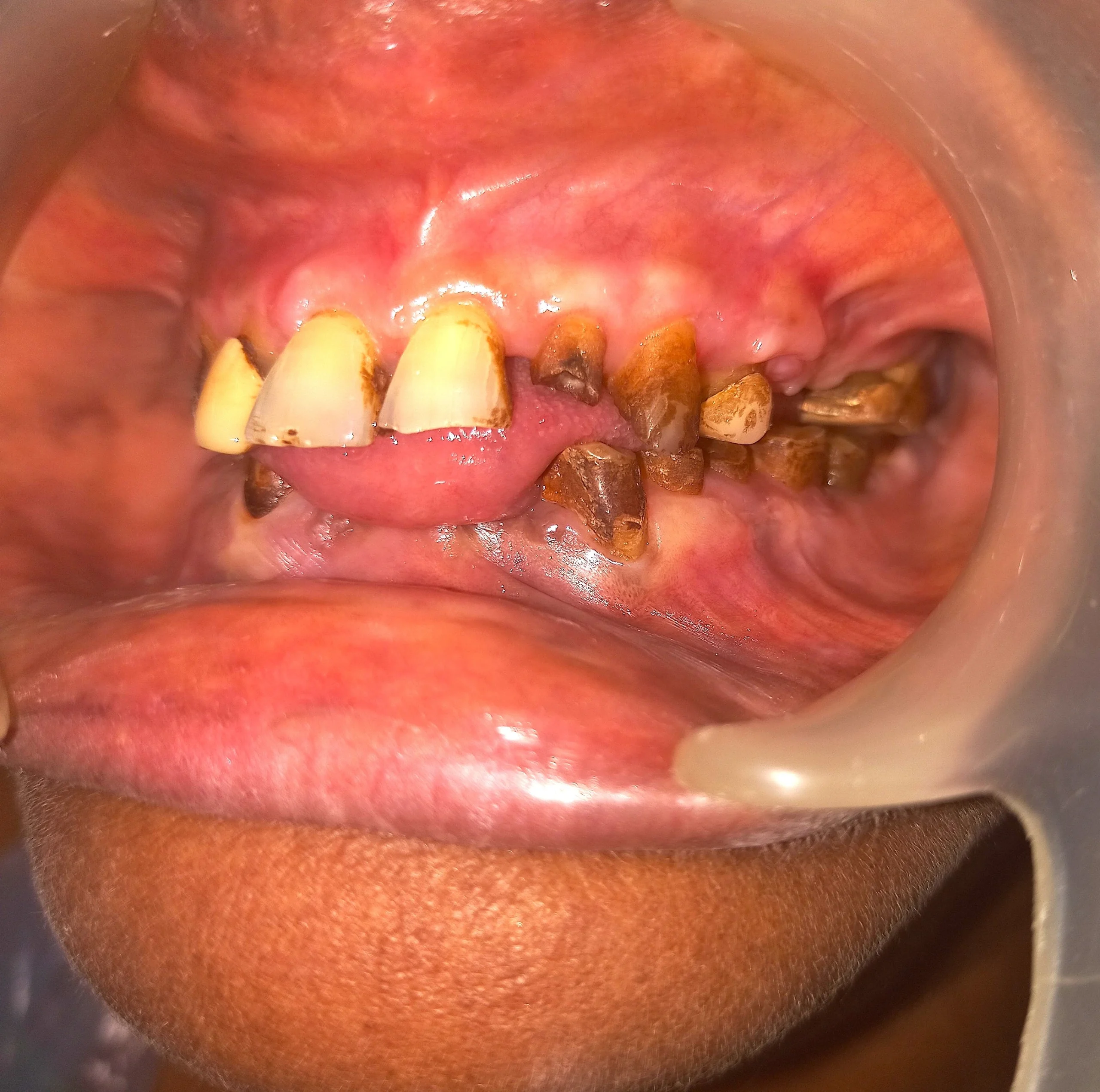 Completely worn out teeth