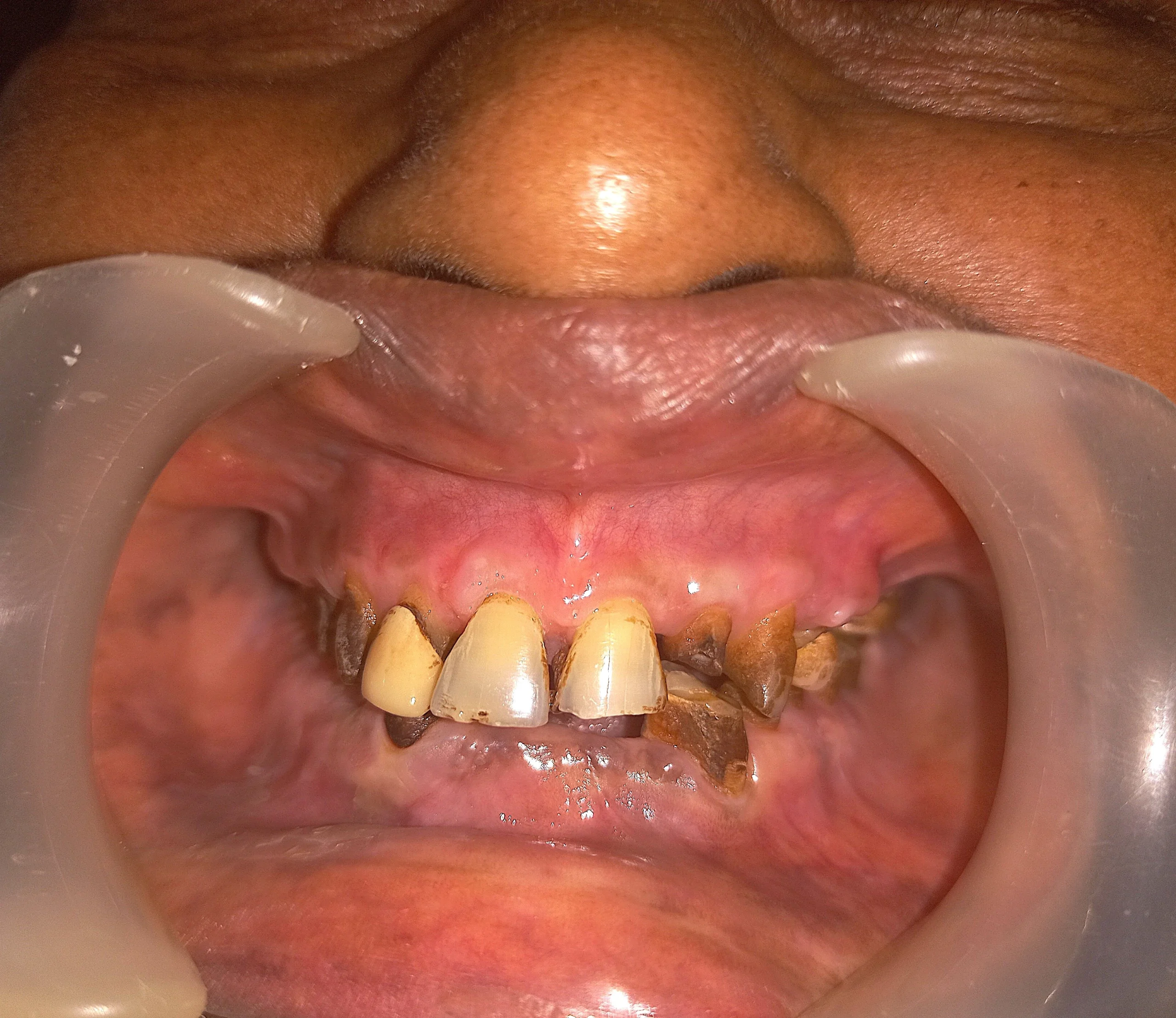 Collapsed bite due to supari chewing