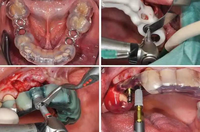 Guided implant surgery for multiple missing teeth in Gurgaon