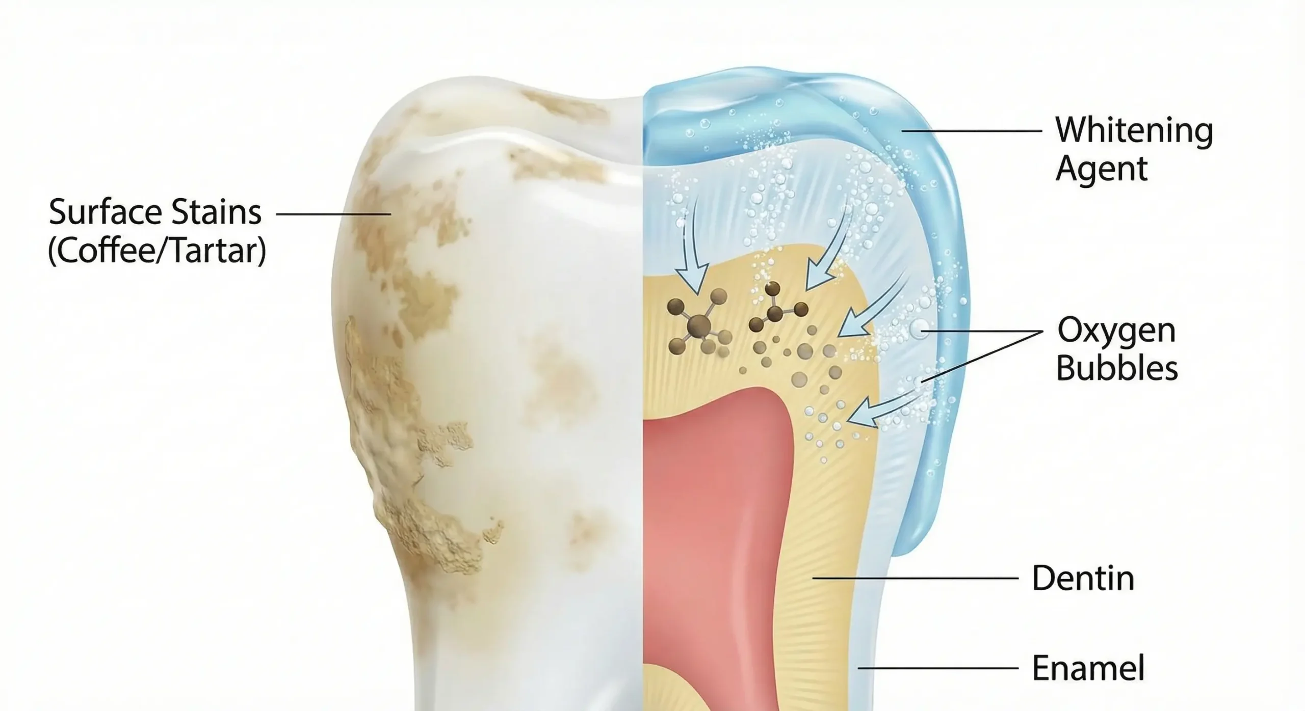 How Teeth Whitening Works Diagram