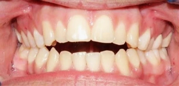 Open Bite Treatment in Gurgaon