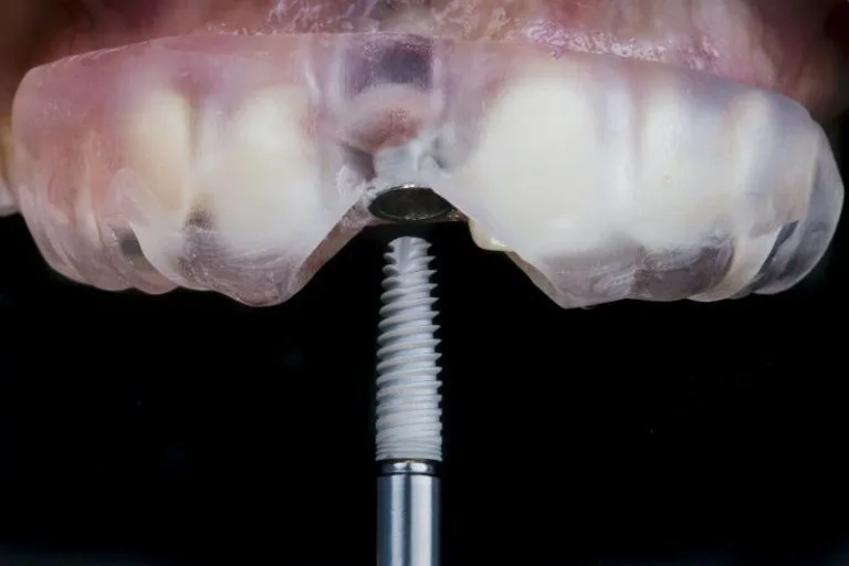 Guided single tooth implant surgery for precise placement