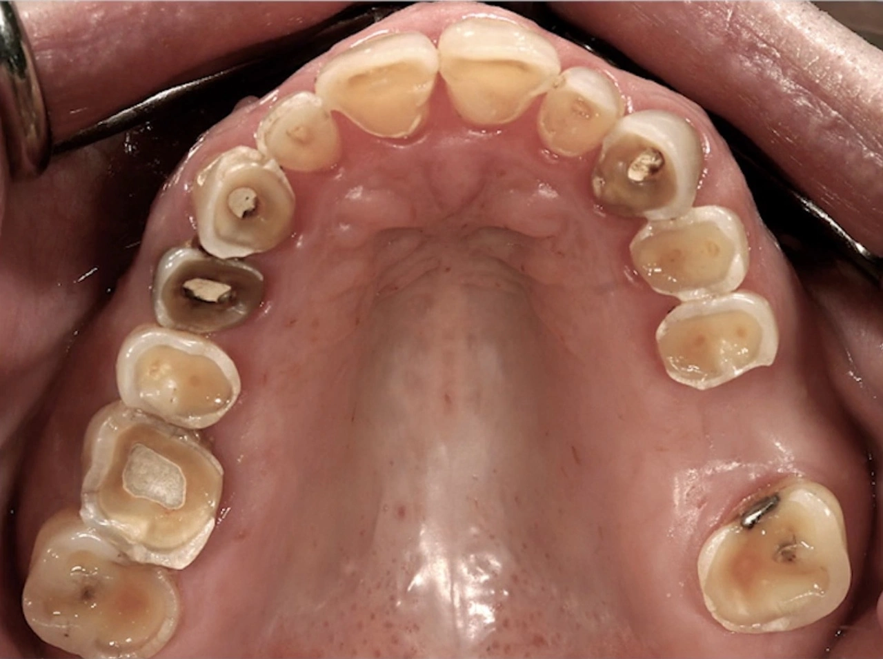 Severe tooth wear showing exposed dentin