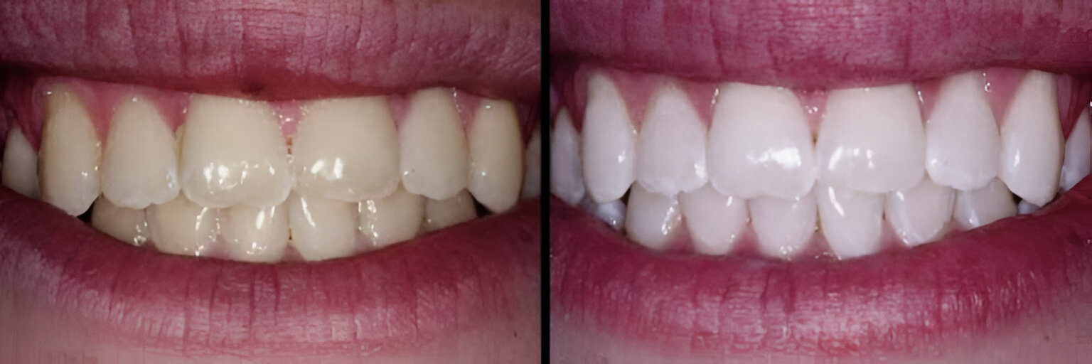 Teeth Whitening Before and After Results in Gurgaon