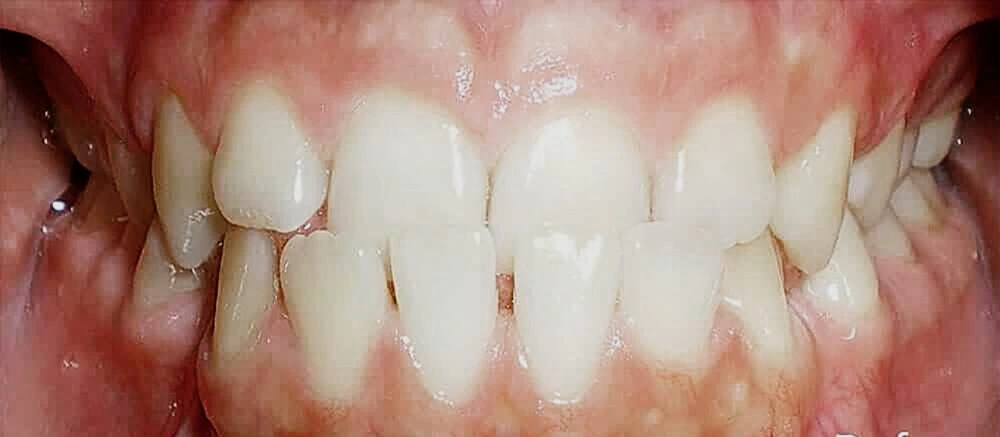 Underbite Treatment in Gurgaon