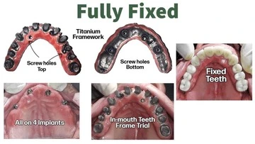 Full Mouth Implants Cost in Gurgaon