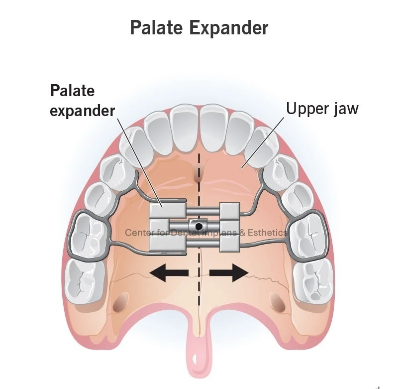 Rapid Palatal Expander