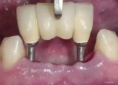 Implant Bridge Cost in Gurgaon