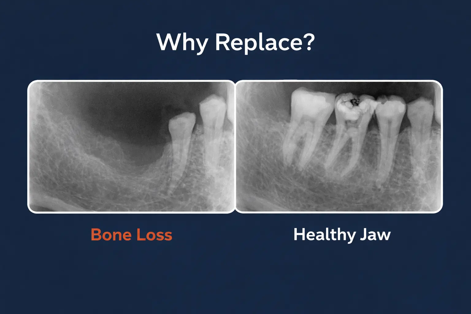 X-ray showing jawbone loss after missing tooth compared to healthy jaw - dental education