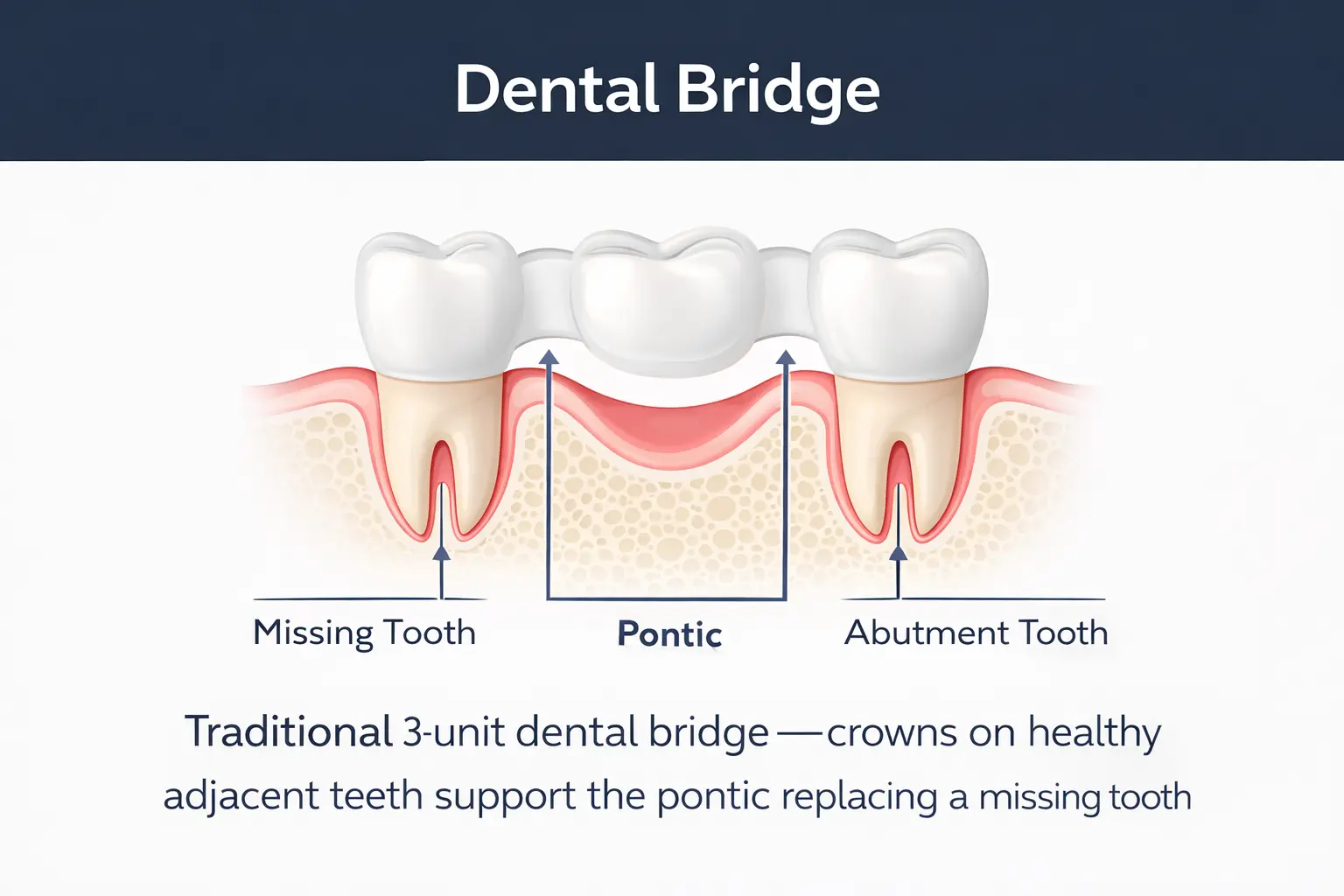 Dental bridge diagram showing 3-unit bridge anchored on adjacent teeth - educational