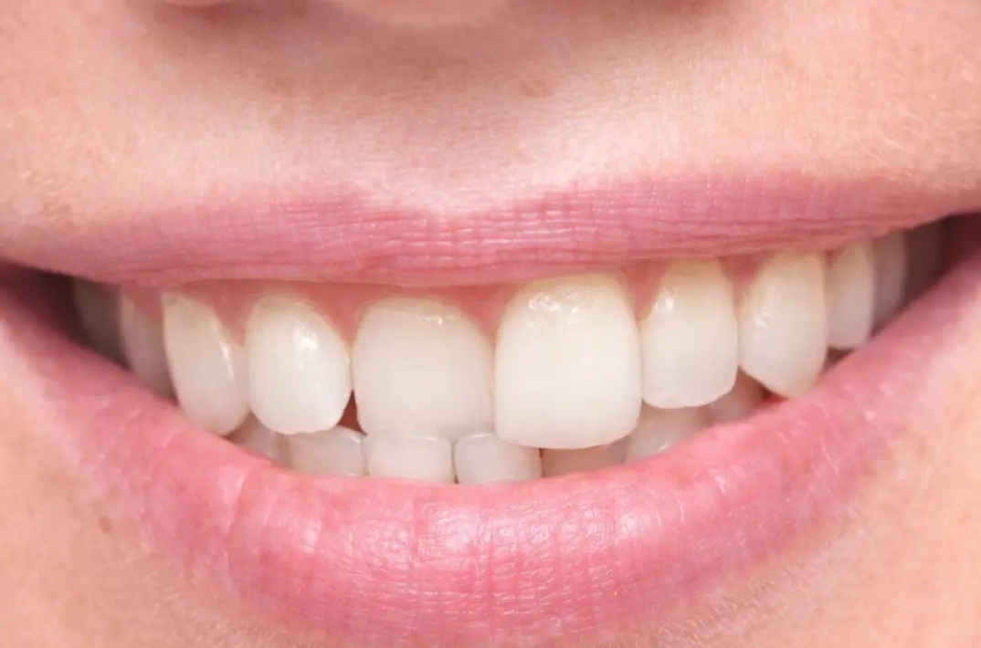 Minor malocclusion crowding — Express aligner plan Gurgaon