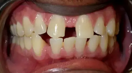 Severe gap in teeth — Comprehensive aligner plan Gurgaon