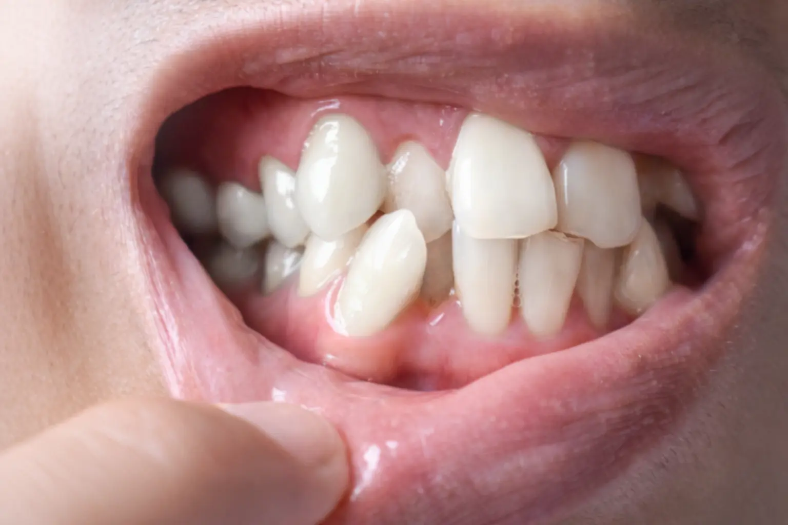 Severe malocclusion bite correction — Comprehensive aligner plan Gurgaon