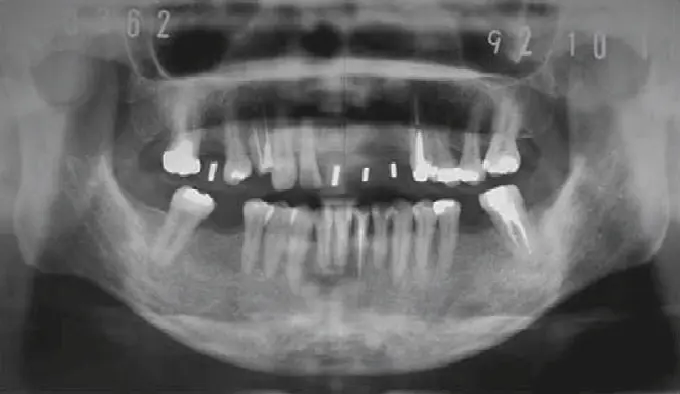 Diagram showing teeth shifting and tilting into gap after missing tooth over time