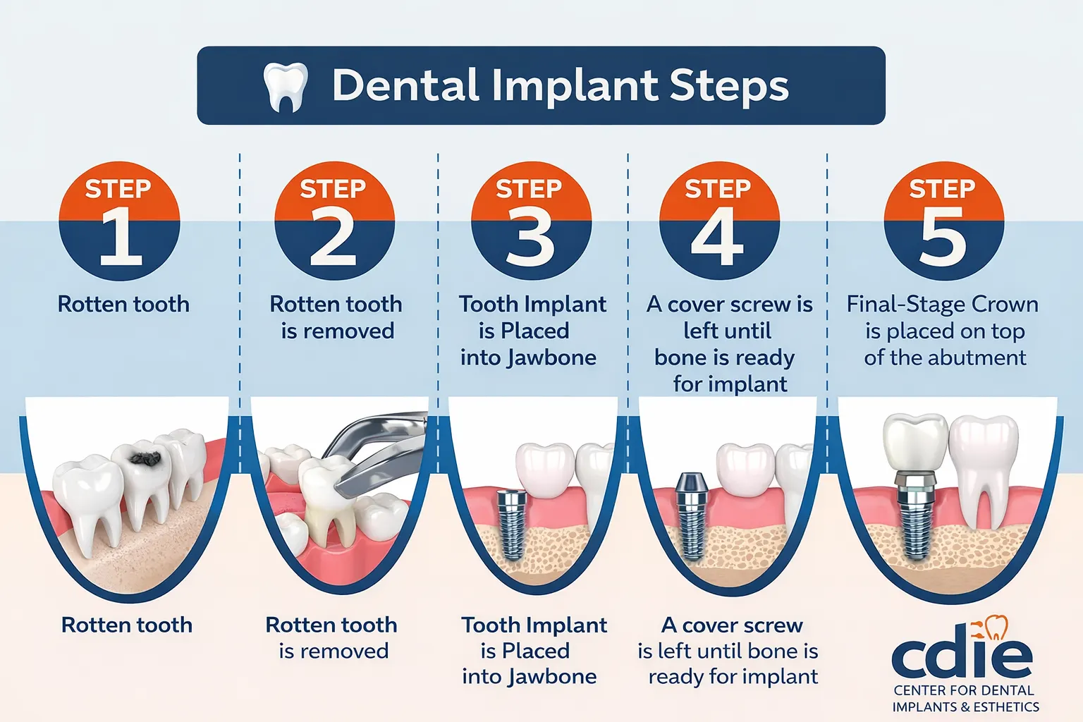 Dental implant diagram showing titanium screw in jawbone abutment and crown - step by step