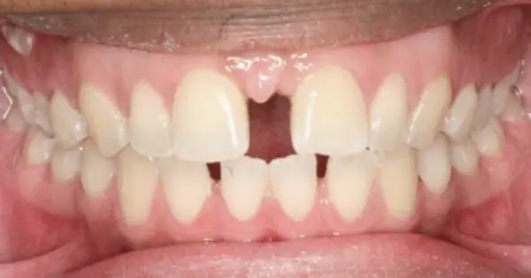 Moderate gap in teeth — Moderate aligner plan Gurgaon