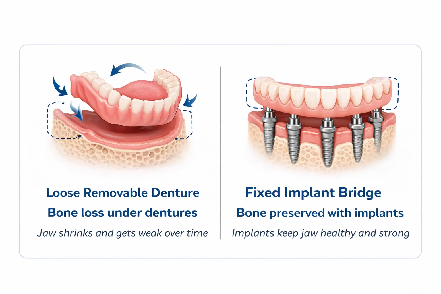 Dentures or All-on-4 implants comparison at Center for Dental Implants Esthetics Gurgaon