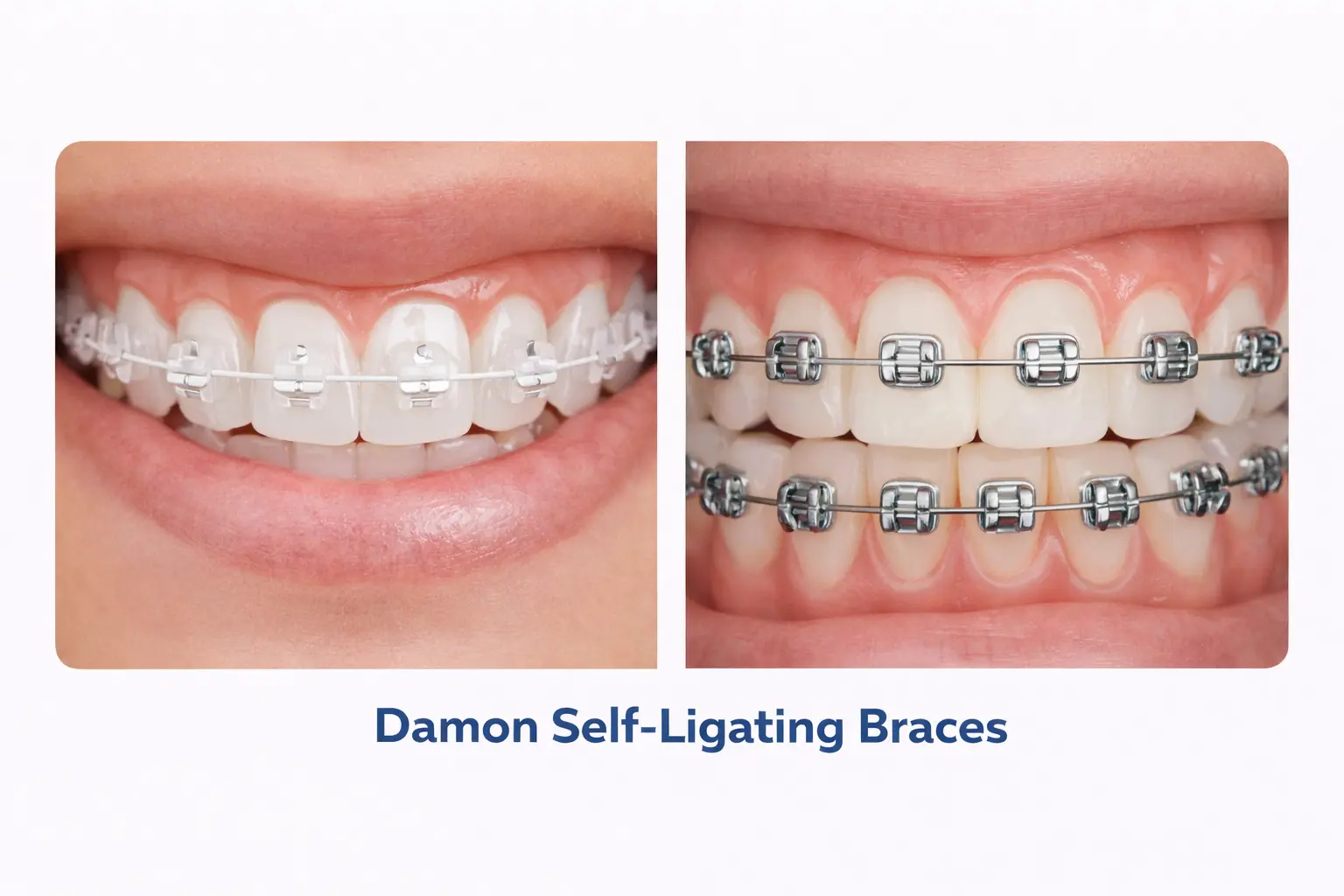 Damon metal braces vs Damon Clear ceramic self ligating braces comparison at CDIE Gurgaon