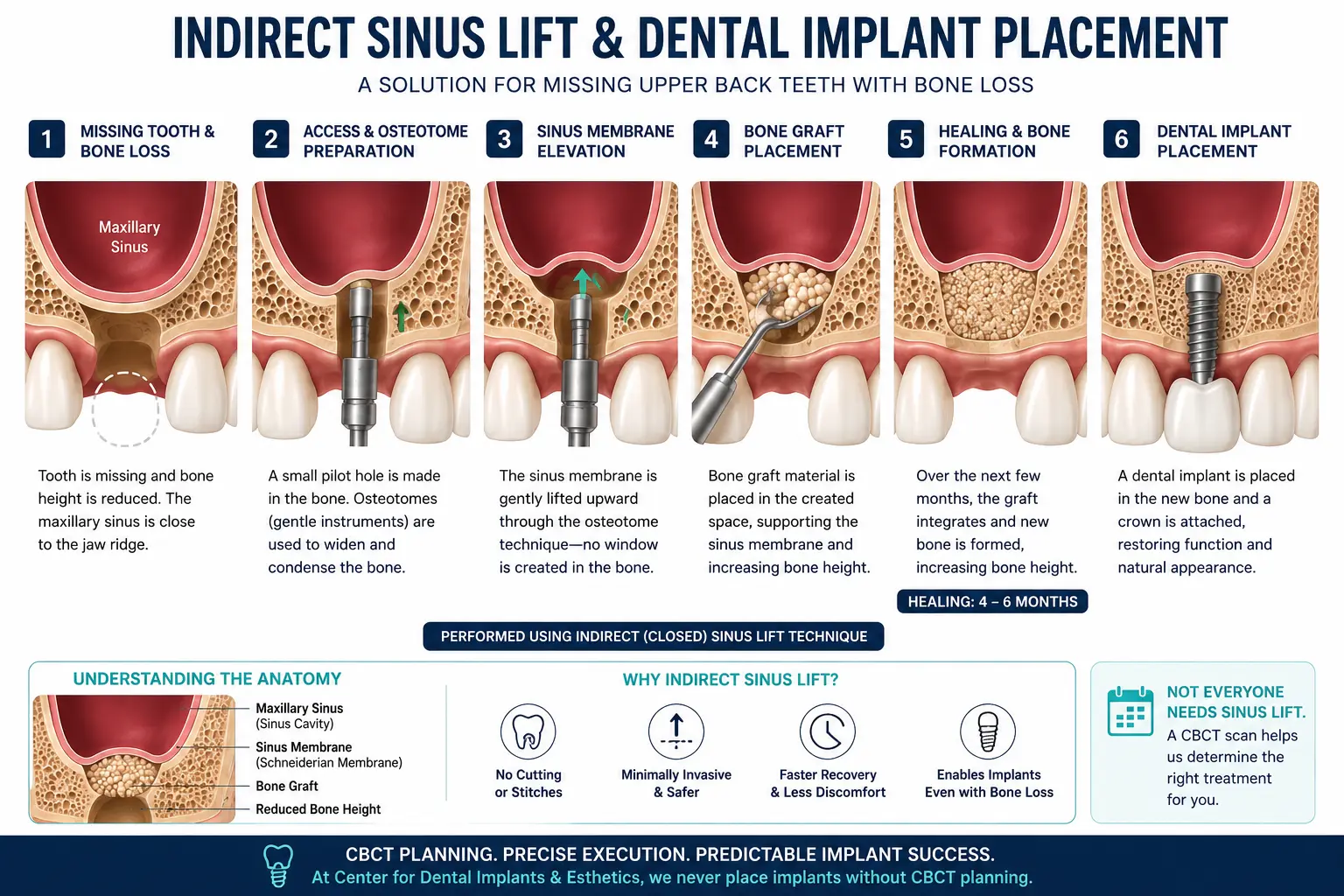 Sinus lift procedure anatomy showing maxillary sinus and bone graft for dental implants