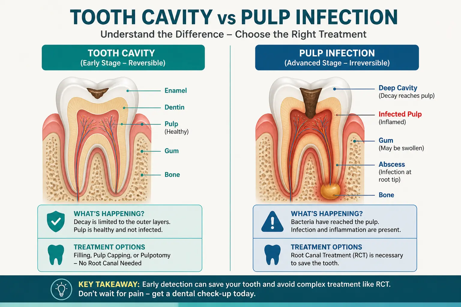 Cross-section diagram showing difference between tooth cavity and pulp infection